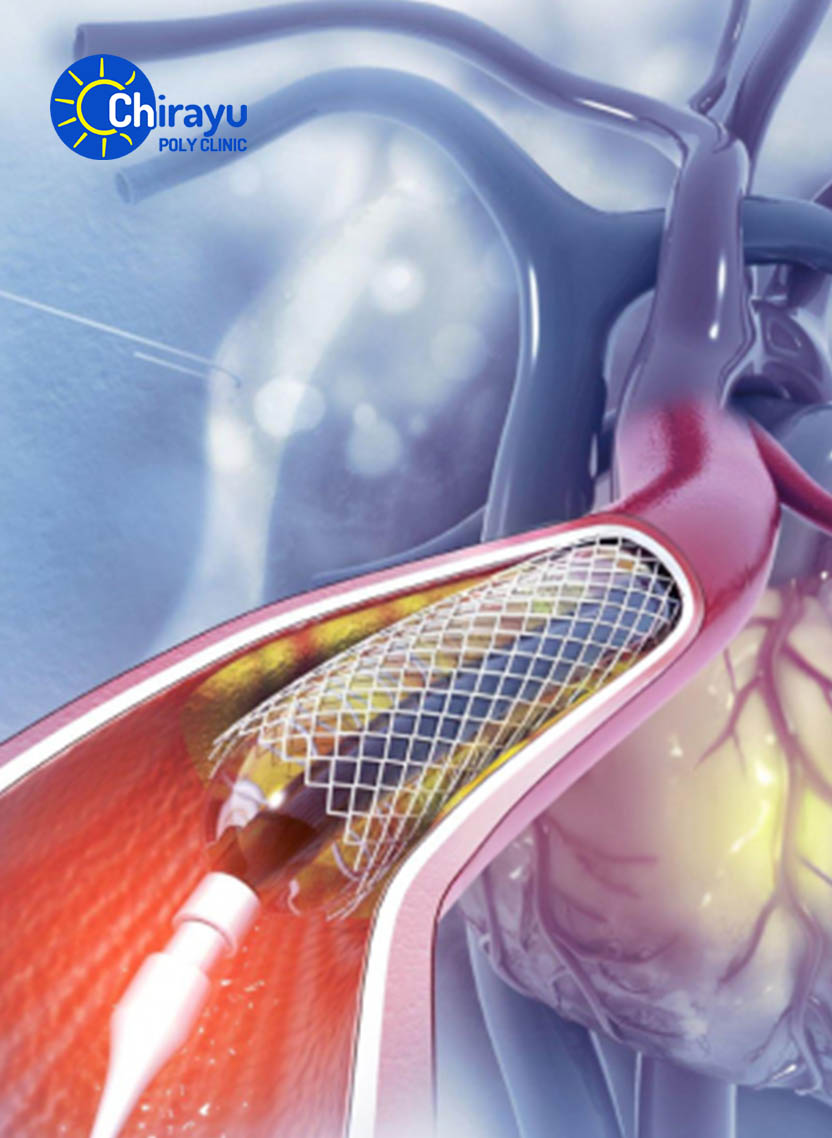 Interventional Cardiology  Services